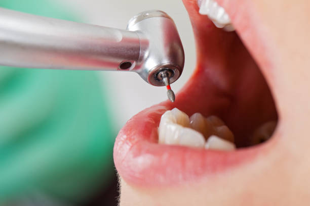Best Emergency Broken Tooth Repair in Bloomingdale, GA